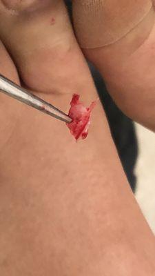 Ingrown toenail