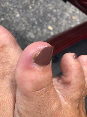 My toe was completely fine when I went in on Saturday. After cutting my toenail with whatever dirty object they use my toe is now inrected.