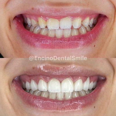 Upper natural smile makeover with gum lift