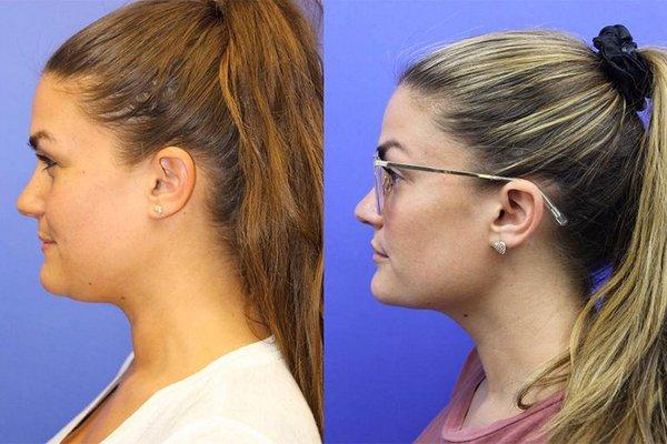 Kybella for chin definition.