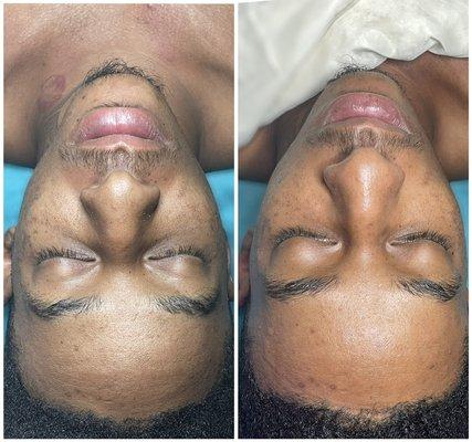 Before (left) and after (right) one session of microdermabrasion. Immediately after you can see the skin brighten and texture even out.