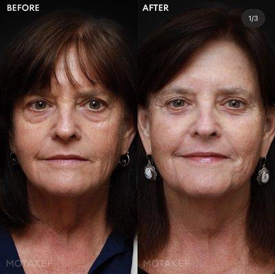 Lower blepharoplasty