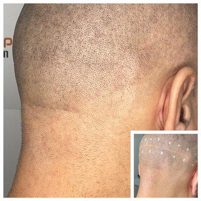 Scar camouflage For (Fut Hair transplant)