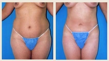 Liposuction