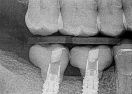 This patient lost both back teeth due to chewing on ice, 2 implants placed and implant crowns.