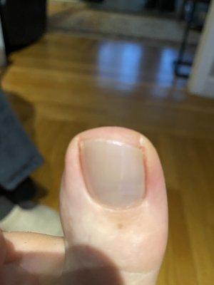 My toe hurts. Cut crooked and too short. I didn't ask for this.