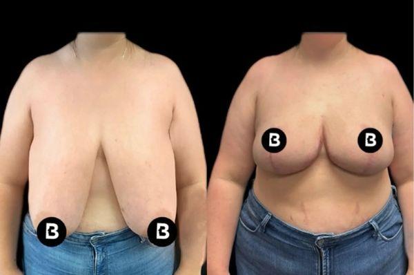 Breast reduction surgery reduces the volume and size of your breasts through the surgical removal of excess breast tissue and skin. ⁠