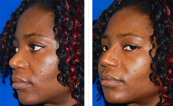 Non-surgical Ethnic Rhinoplasty