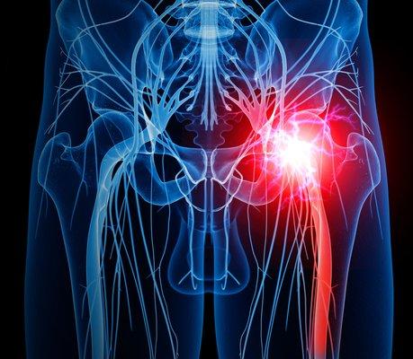 Sciatica Nerve Pain and the BPR Method™️