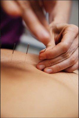 Acupuncture wellness sessions available