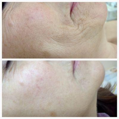 Before and after 8 treatments!