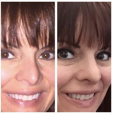 Before and after having nasal dorsal implant which Dr. Vu placed, removed (by another surgeon).