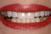 "Veneers"