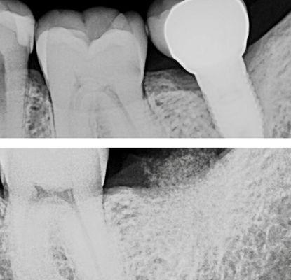 Dr Y removes the failing implant and regenerates the bone with a PRF