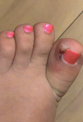 INFECTED TOE NAIL