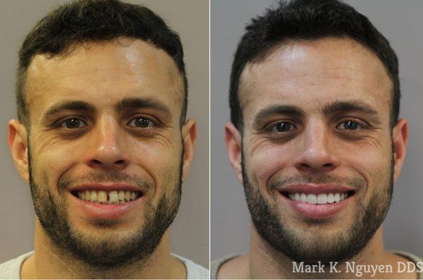 Smile transformed with Emax veneers. Patient had been unhappy with the discolored bonding done by his previous dentist.