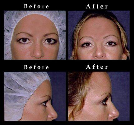 Upper eyelid surgery: Blepharoplasty
 Learn more about the procedure:
 http://www.enhancedform.com/eyelidsurgery/