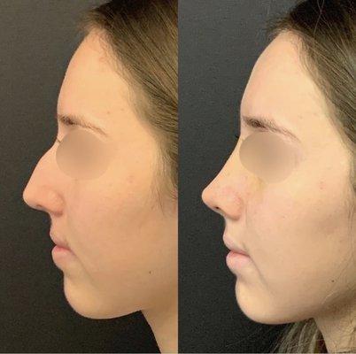 Rhinoplasty before and after.