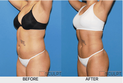 XSculpt Body Transformation Patient: SculpSure Laser Fat Reduction, Bioidentical Hormone Therapy, MK, Personal Training