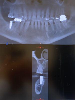 Perfect implant!  Surgical guide used.