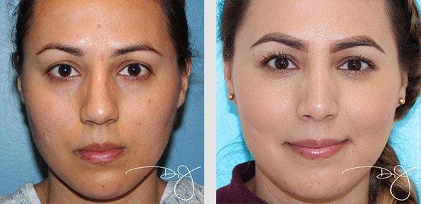 Rhinoplasty