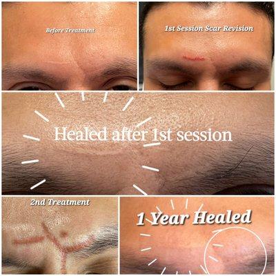 Scar Revision Sessions & Healed results.