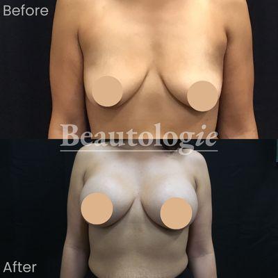 Bilateral Breast Augmentation with 500ml Saline Implants Before and After by Dr. James Knoetgen