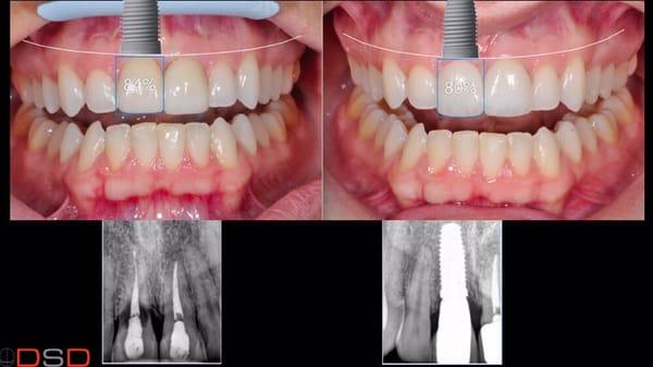 Replacing a front tooth with a dental implant is very challenging.  Trust an AACD accredited cosmetic dentist.