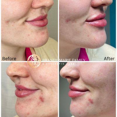 Before and After Lip Filler