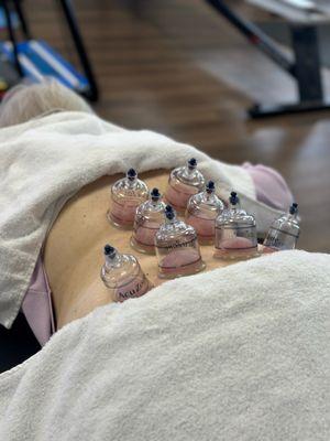 Cupping on the low back area to reduce pain, tension, and dysfunction. Increase blood flow to speed up recovery.