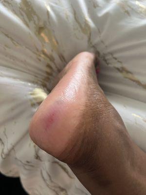 Injury on my foot from pedicure