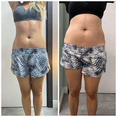 8 Week Weight Loss Program (Non Surgical)