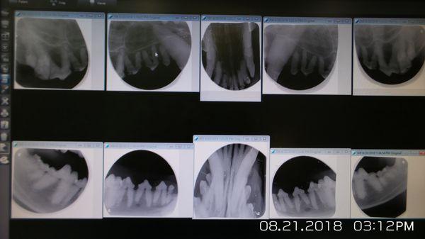 A proper dental assessment and cleaning cannot be done with our full mouth dental X-rays!