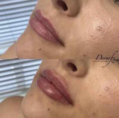 1 syringe of Juvederm Volume in the lips