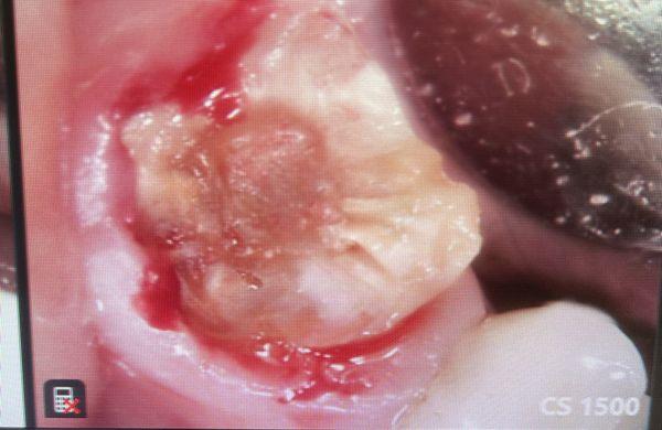 Tooth was TOTALLY destroyed below the gum level. No temporary crown could be installed!