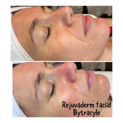 Rejuvaderm facial by Tracy Le