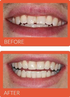 Before and After Photos - Alpine Meadows Family Dental in Lehi, UT http://www.alpinemeadowsfamilydental.com/our-office