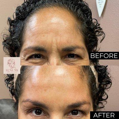 Anti-wrinkle treatment