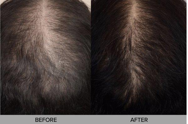 PRP for hair restoration before and after photos