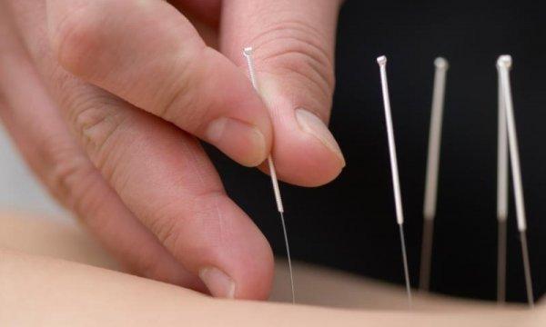 Medical Acupuncture in the heart of downtown Austin