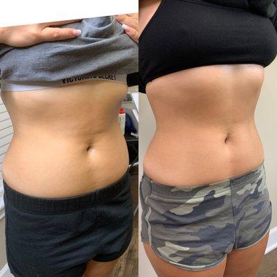 Lipo Cavitation & Radio Frequency Body Contouring And Skin Tightening