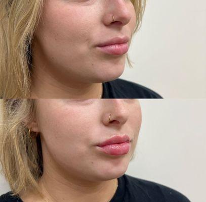 lips before and after