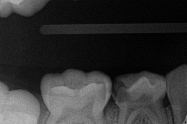 2/16/2022 X-ray taken of infected tooth