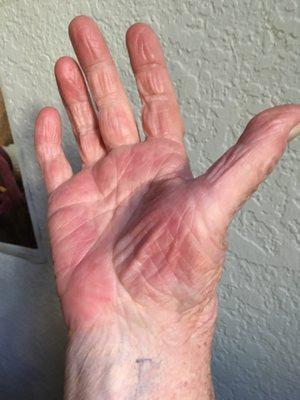 Palm side : Notice the hot red  skin and the deformed thumb, this is classic RSD.