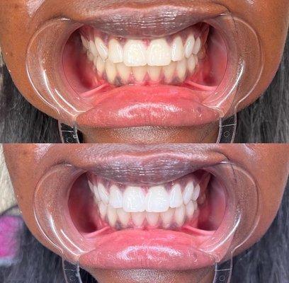 1hr  Teeth Whitening service