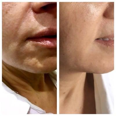 Microneedling session 3