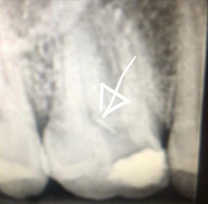 That small line is an object, a piece of metal that was left inside my tooth (unknown to me) until my visit to a different dentist,