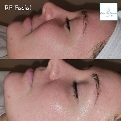 RF Facial