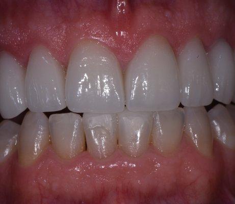 Porcelain veneers and crowns