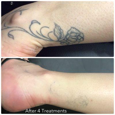 Tattoo removal with PicoSure